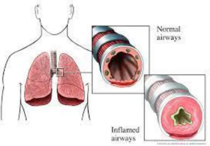 Figure 01 : Asthma 