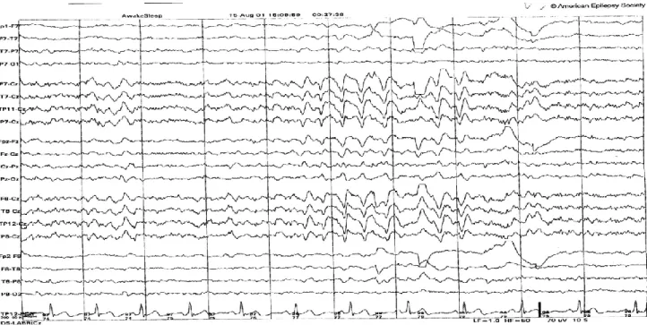 Figure 2.2 REM sleep is characterized by a more typically wake-appearing, desynchronized,  mixed-frequency background, which may contain alpha frequencies, characteristic centrally  dominant sharply  contoured sawtooth waves, and rapid eye movement artifac