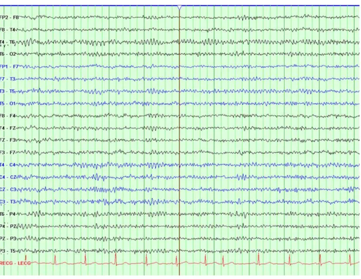 Fig: 3.5 Scalp EEG recording of ictal onset in a patient with absence epilepsy using a  longitudinal bipolar montage