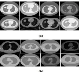 Figure 3.1: Samples of images a) Malignant b) Benign form (LIDC dataset)[58]