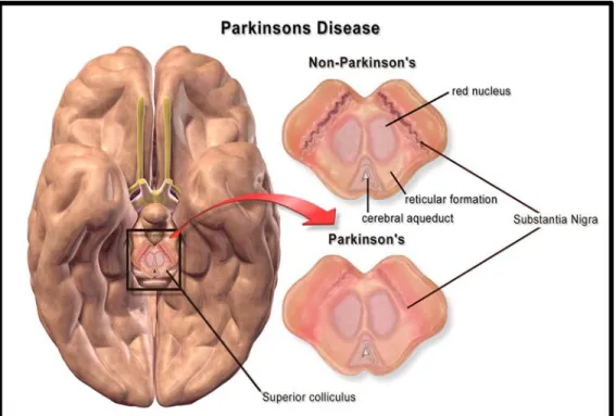 Figure 1: Difference between Parkinson’s and Non-Parkinson’s brain (Embogama, 2016). 