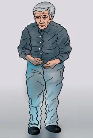 Figure 3: Illustration of No Facial Expression and Rigid Posture of a Patient with Parkinson’s Disease  (Adapted from (Lees et al., 2009)) 