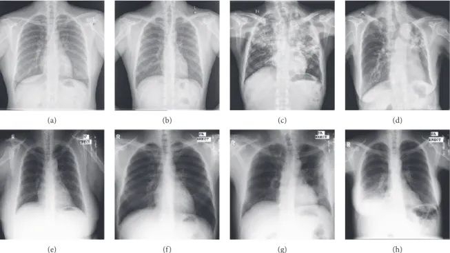 Figure 1: Training and validation CXR from both Shenzhen and Montgomery datasets. (a) Normal CXR of a 38 yr female