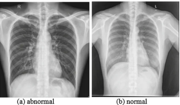 Figure 4.1: Normal and abnormal CXR