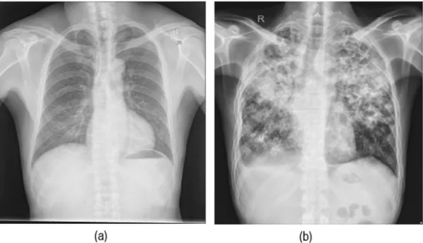Fig. 1. Sample in the Shenzhen Database. (a) is a healthy chest radiograph of a 60 years old male patient while (b) is an unhealthy chest radiograph of a 36 years old male patient diagnosed with “bilateral pulmonary TB”.