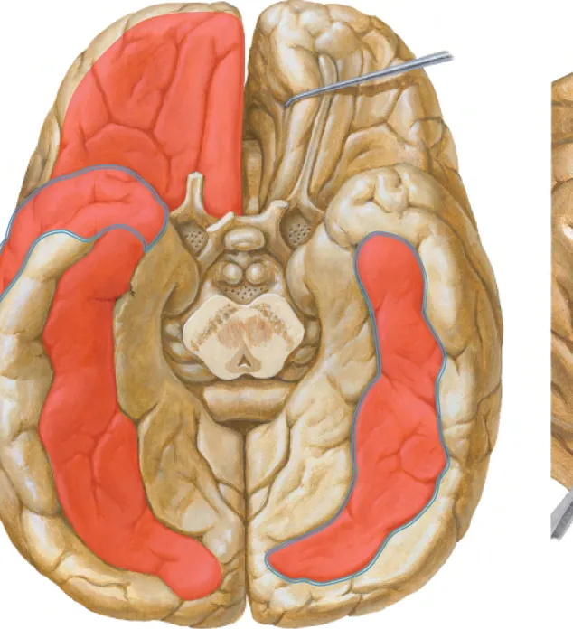 Figure 1b: Graphic representation of alterations in cortical thickness  Inferior view of the whole brain (left); lateral view of the right  hemisphere (right) of which the operculum and superior temporal  gyrus is retracted to demonstrate the insula