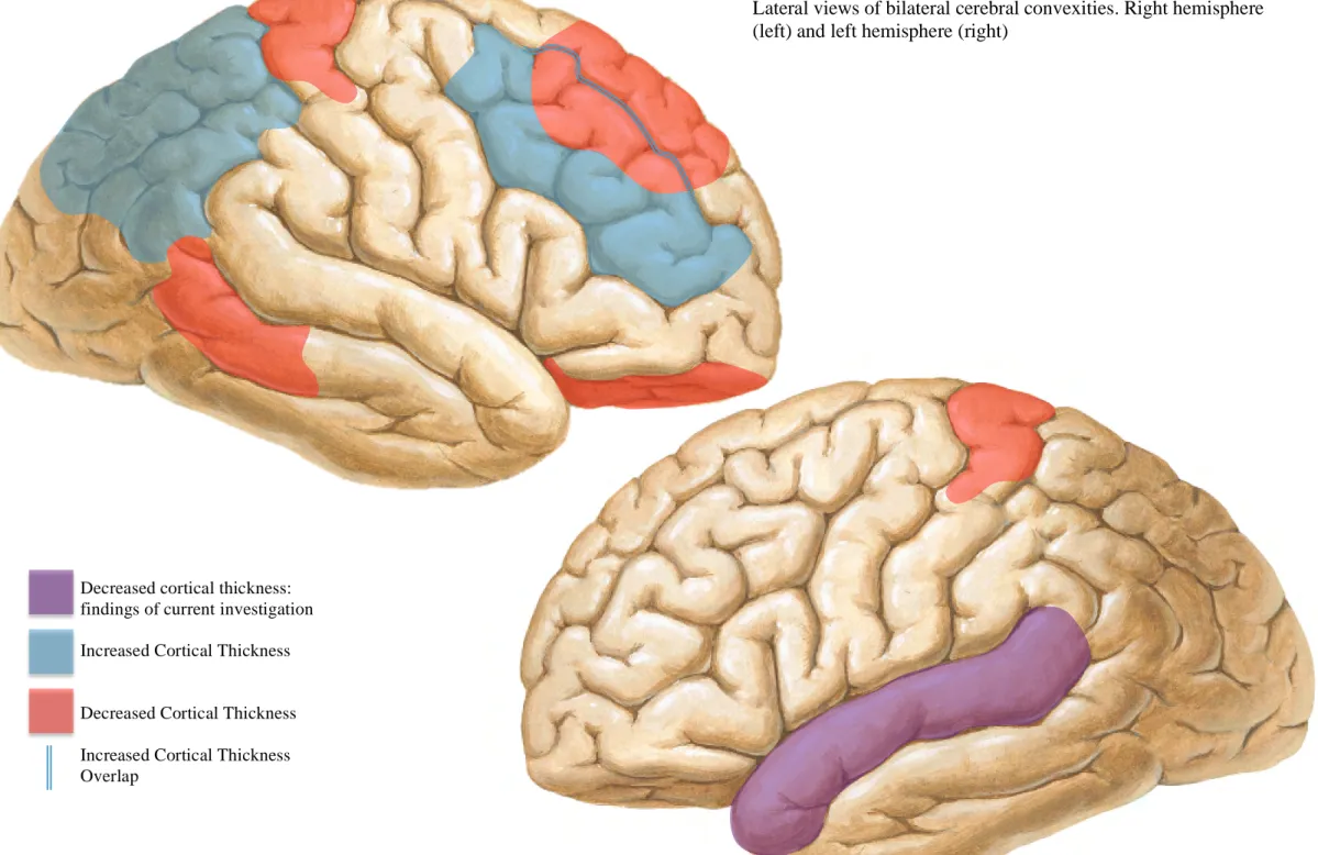 Figure 1c: Graphic representation of alterations in cortical thickness  Lateral views of bilateral cerebral convexities