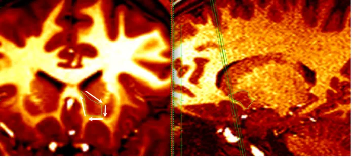 Diagram  demonstrating  the  tracing  outline  of  the  accumbens, and the inclusion of all the nuclear subgroups