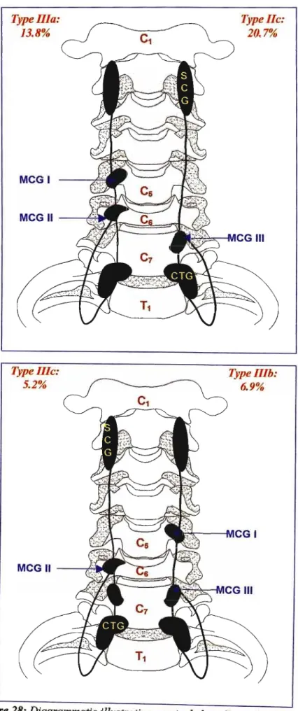 Figure 28: Diagrammatic illustration cervical chain Types Ilc, IIla, IlIb and lIfe