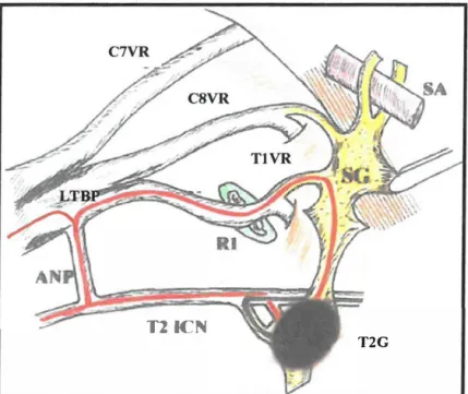 Figure  17: T2 ganglionectomy interrupts sympathetic outflow to the brachia! 