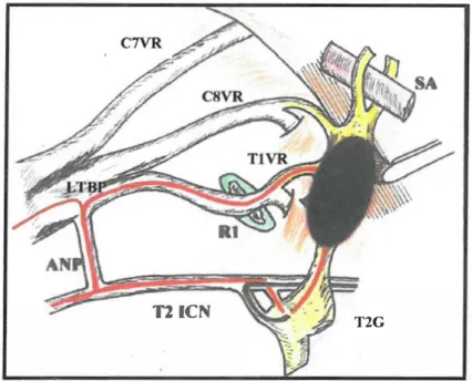 Figure 6: The neural pathway to the brachia/ plexus is not interrupted by  ste/late ganglionectomy when an alternate neural pathway is present 