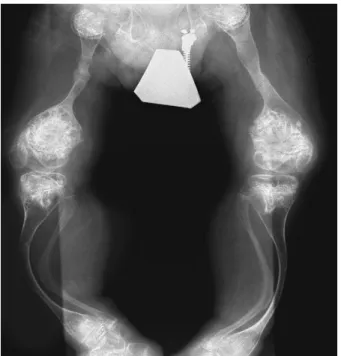 Figure 1. Bilateral lower limb radiograph shows “popcorn” appearance of the  epiphyses