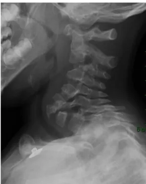 Figure 5. Lateral radiograph of the cervical spine showing the hyperextension  deformity at the cervicothoracic junction 