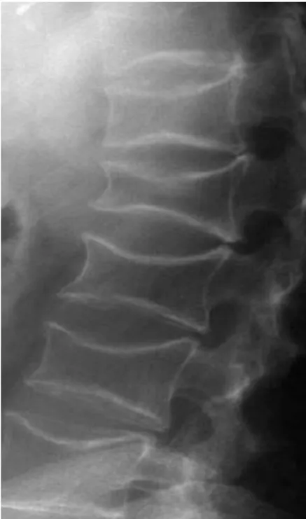 Figure 4. Lateral radiograph of thoracolumbar  spine demonstrating cod  fish vertebra appearance (biconcave compression fracture s) 