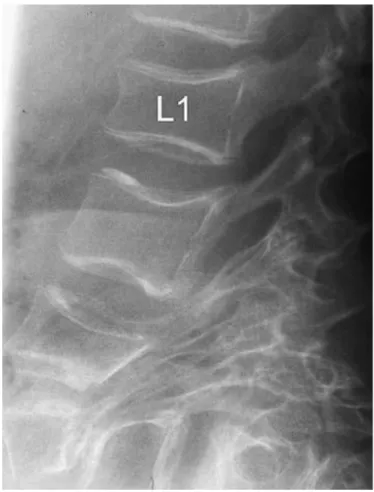 Figure 6. Lateral radiograph of upper lumbar spine, showing spondylolisthesis caused  by extreme elongation of lumbar pedicles