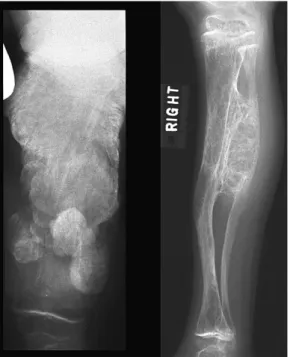 Figure 7. Hyperplastic callus resembling osteosarcoma 