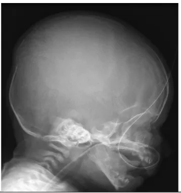Figure 11. Lateral radiograph of skull in OI demonstrating wormian bones 