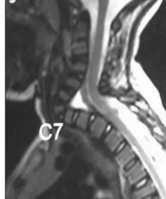 Figure 1. Sagittal X-ray of Cx spine showing the 