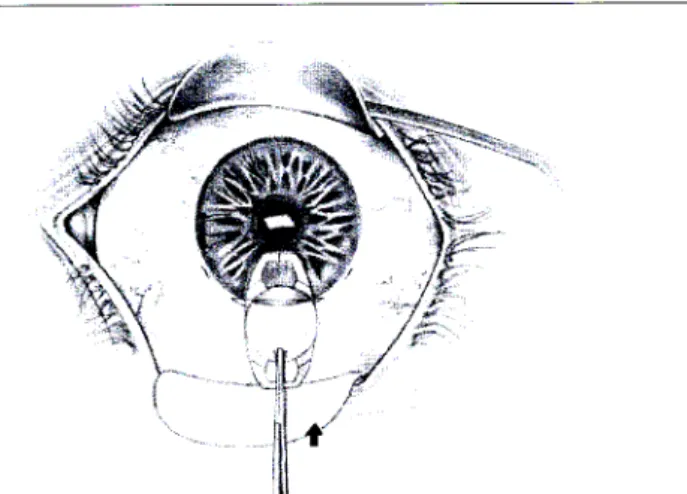 Figure 2.4: Lens stabilised while enclaving Figure 2.3: Lens rotation