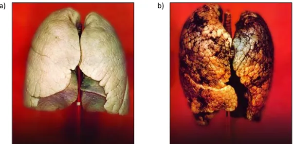 Figure  1.1.  a)  Normal,  healthy  lungs,  contrasted  with  b)  the  lungs  of  a  smoker
