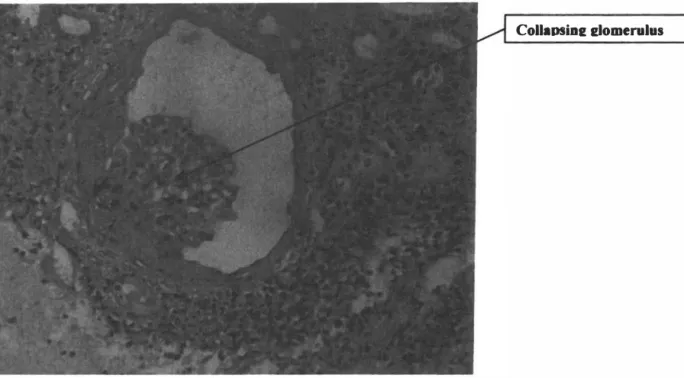 Figure 22. Classical HN AN ( collapsing glomerulus) 