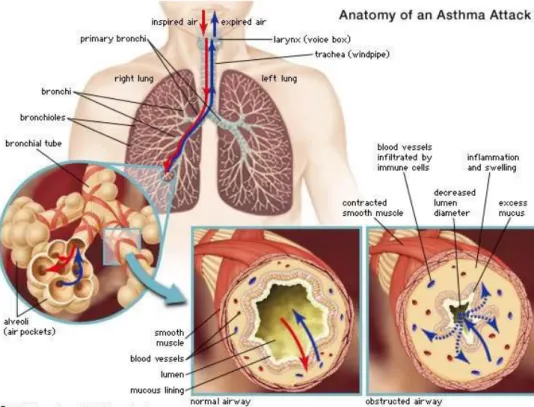 Figure 1.1   Demonstration of the cross-sections of a normal and obstructed  airway  (an  airway  when  asthma  symptoms  arise)  (ENCYCLOPEDIA  BRITANNICA, 2001) 