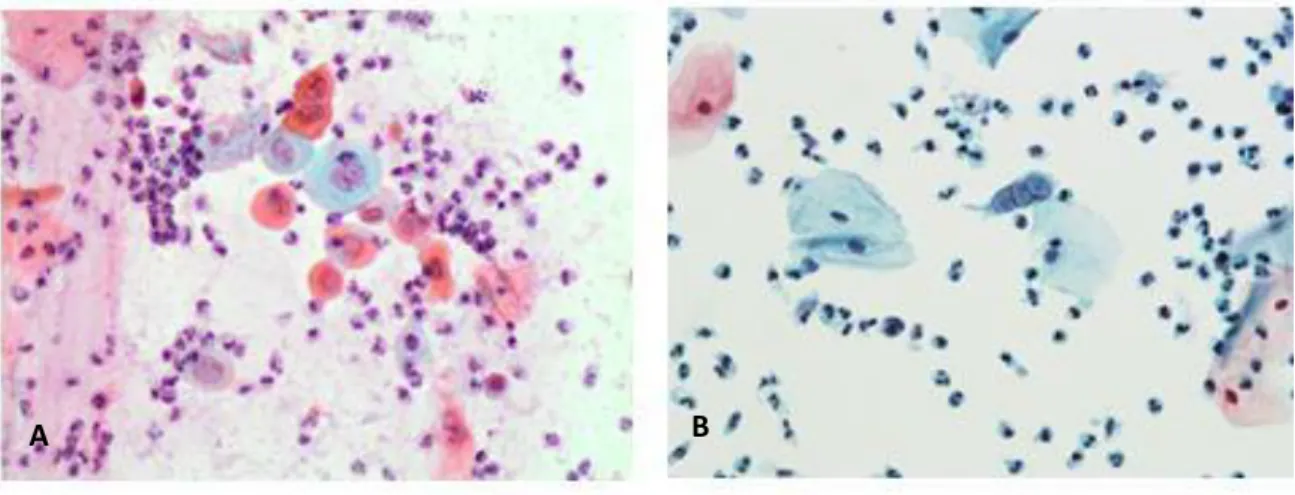 Figure  1.8  A)  Pap  40x:  showing  cells  which  are  not  well  preserved  and  there  is  excess  background mucus and inflammatory cells