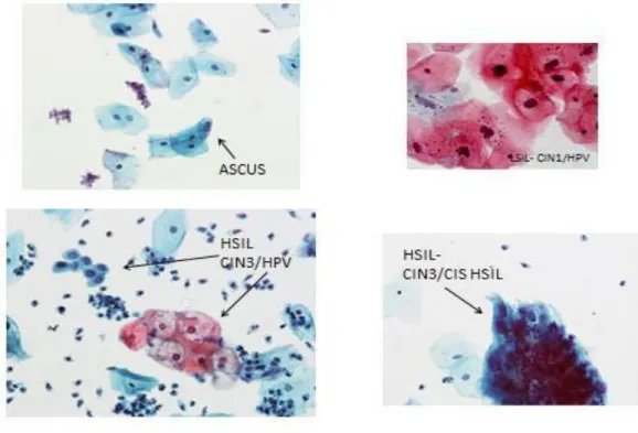 Figure 1.10 LBC 40x epithelial cell abnormalities as seen in cervical cytology samples