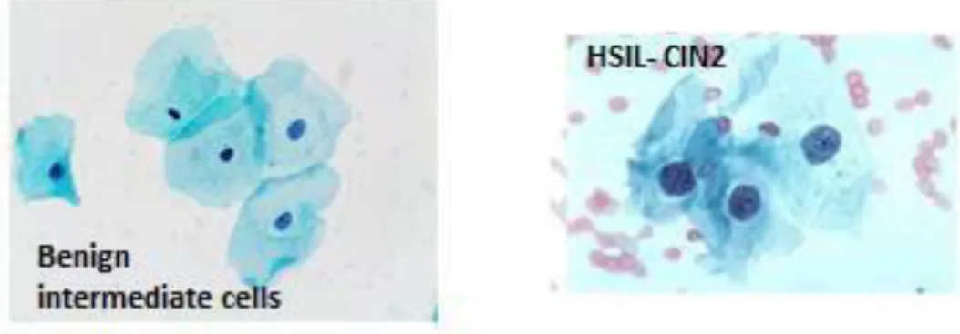 Figure 1.13 Pap 40 x A) HSIL- Cells from CIN2 and CIN3, B) HSIL- CIN3 Cells with  marked hyperchromasia and a small volume of cytoplasm