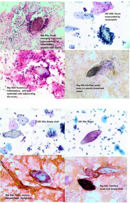 Figure 1.14 Pap and LBC 40x: Ova of Schistosoma haematobium were seen in varying  presentations in the Pap smears and LBC samples as described in Paper 2, additional  images are depicted