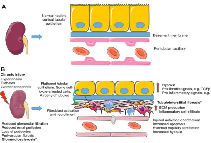 Figure 1: The pathophysiological processes linked to FSGS. (A) A healthy, normal kidney (left), and 
