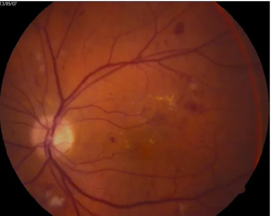 Figure 1 - Diabetic maculopathy with clinically significant macular oedema. 