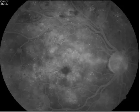 Figure 3 – Fluorescein angiogram - chronic diffuse cystoid diabetic macular oedema.