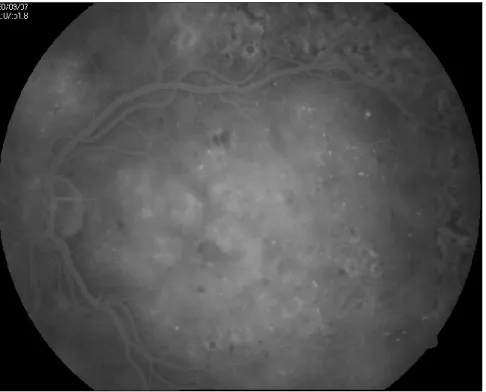 Figure 2 – Fluorescein angiogram - diffuse diabetic macular oedema and previous argon  laser retinal scarring.