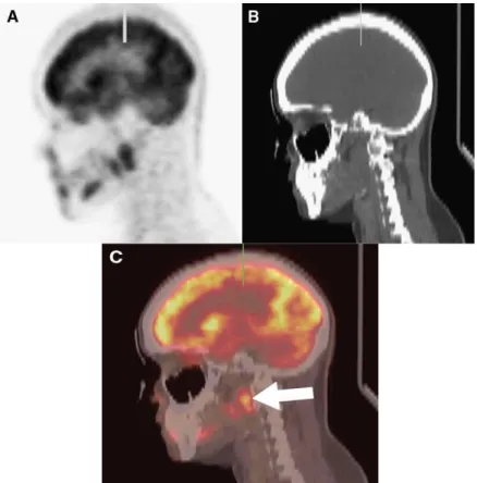Figure 2.7: Tumor localization and image alignment with a PET/CT scanner: A and B is the sagittal PET and reformatted CT images of the head