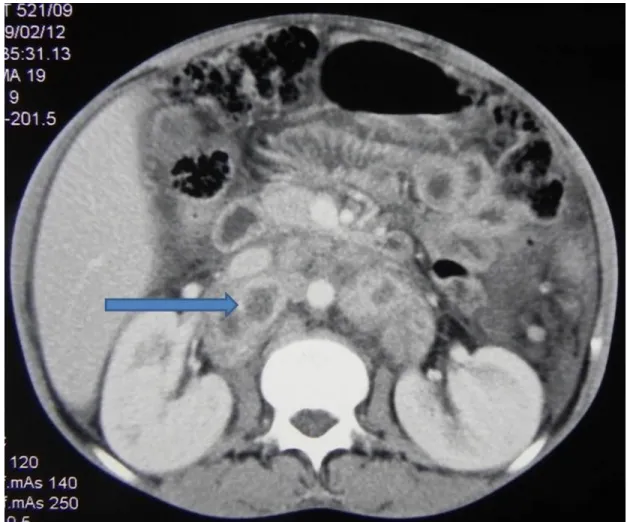 Figure 2: CT scan showing enlarged retroperitoneal lymph nodes (arrow) with central area  of necrosis; histology was positive for TB