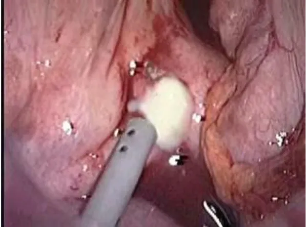 Figure 6: Mesenteric lymph node with pus 