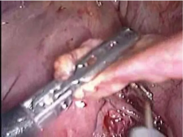 Figure 8: Taking biopsy from the omentum. 