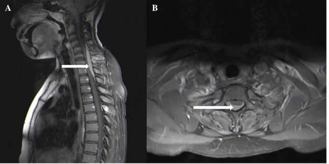 Figure 1: Cervico-thoracic T1W sagittal (A) and axial (B) post contrast MRI showing a lymphoma (arrow) in a 38-year- 38-year-old male patient, causing spinal cord compression