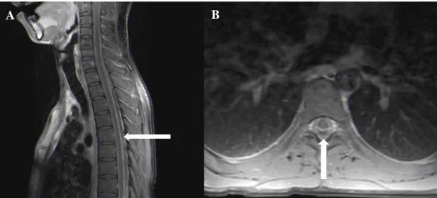 Figure 2: Thoracic T1W sagittal (A) and axial (B) post contrast MRI showing a lymphoproliferative disease (arrow) in a  28-year-old male patient, causing spinal cord compression.