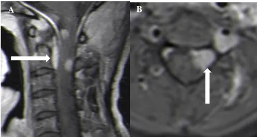 Figure 4: T1W (pre and post gadolinium) sagittal (A and B) and axial (C) MRI showing an invasive paravertebral  cervical mass diagnosed as EBV associated MT extending into the spinal canal resulting in spinal cord compression, and  causing expansion of the