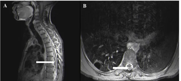 Figure 5: T1W post contrast thoracic MRI (A and B) showing a T1 – T7 long level extradural pyogenic abscess (see  arrow) in a 23-year-old male patient