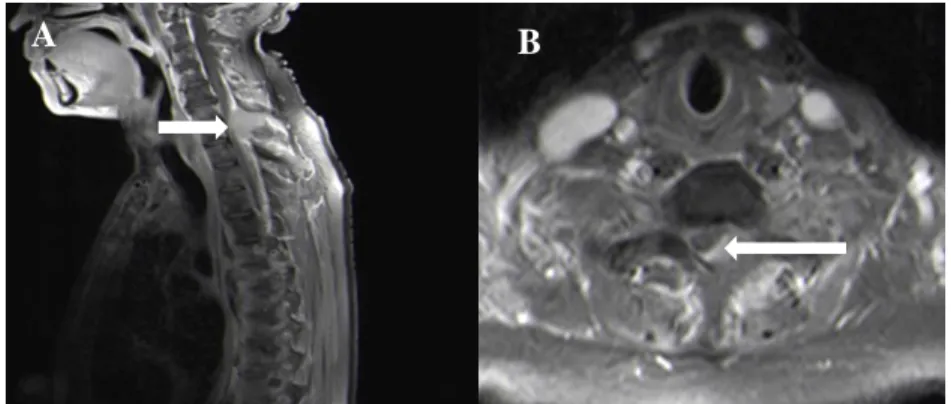 Figure  6:  T1W  (post  gadolinium)  sagittal  (A)  and  axial  (B)  MRI  of  the  thoracic  spine  showing  a  metastatic  ovarian  carcinoma (arrow) in a 30-year-old female causing spinal cord compression