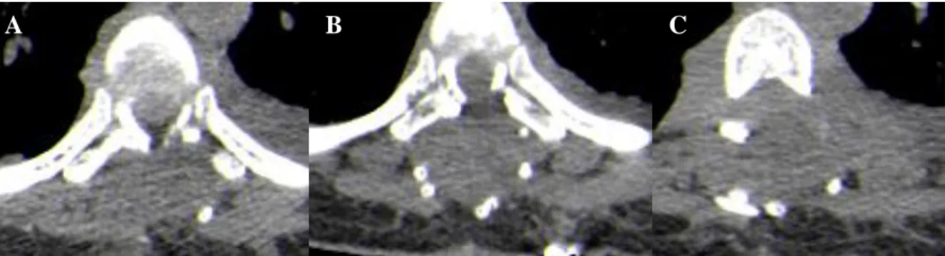 Figure 7 (a): Axial (A, B, and C) views of CT scan of the thoracic spine  in a 30-year-old female with  metastatic ovarian  carcinoma showing extensive destruction of the posterior elements of the spine