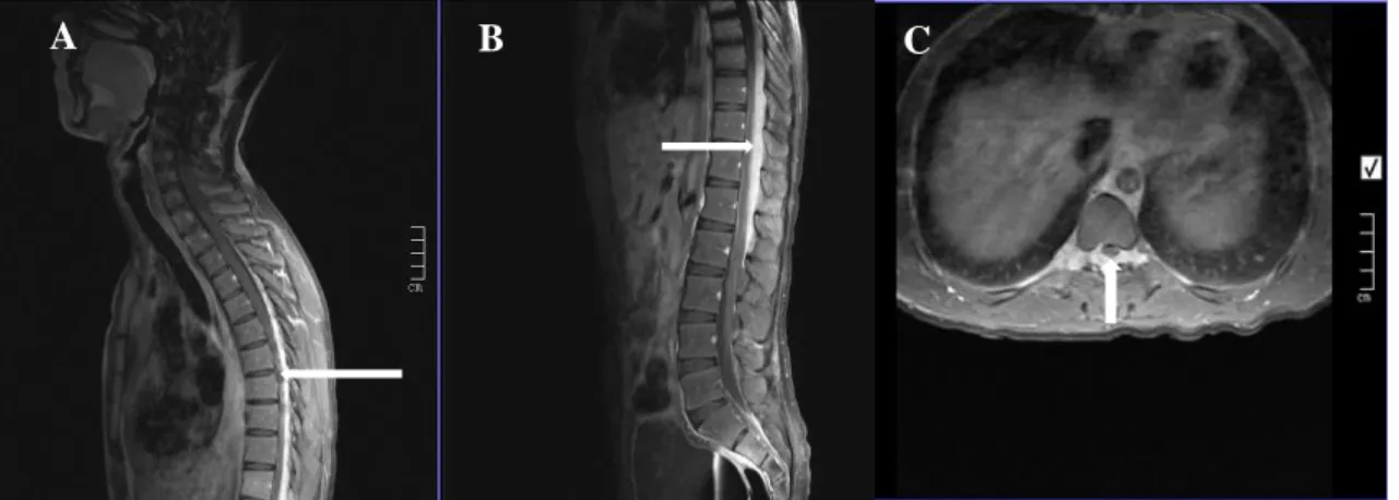Figure 8: T1W (post gadolinium MRI) sagittal A, B and  axial C  of the thoracic  spine showing a  Rosai-dorfman  disease  extending from T2 to L2, a well circumscribed homogenous enhancing extradural mass with spinal cord compression in a  23-year-old male