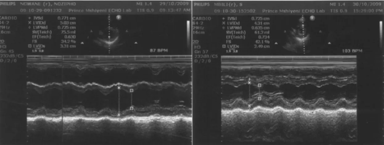Figure  1a: M-Mode  recording  in  a normotensive  patient  (A)  and  in  a  pre-eclamptic  patient (B)