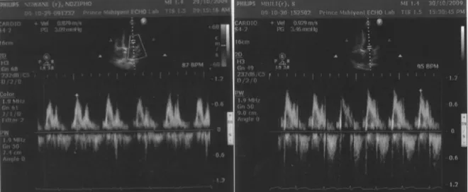 Figure 1b: Doppler recordings in a normotensive patient (A) and in a pre-eclamptic  patient (B) across the mitral valve
