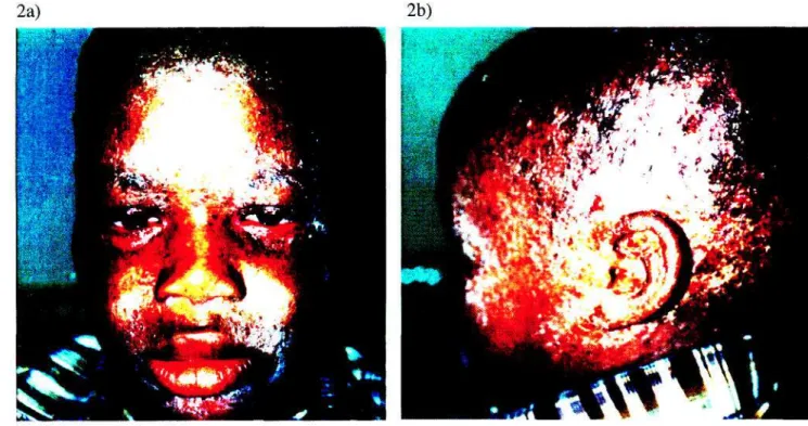 Figure 2a and 2b: Clinical picture of a relapse in a patient with HAID 