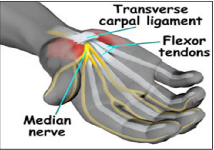 Figure 1.Compression of the median nerve (Bartholet, 2001)  2.4.2. Signs and symptoms 