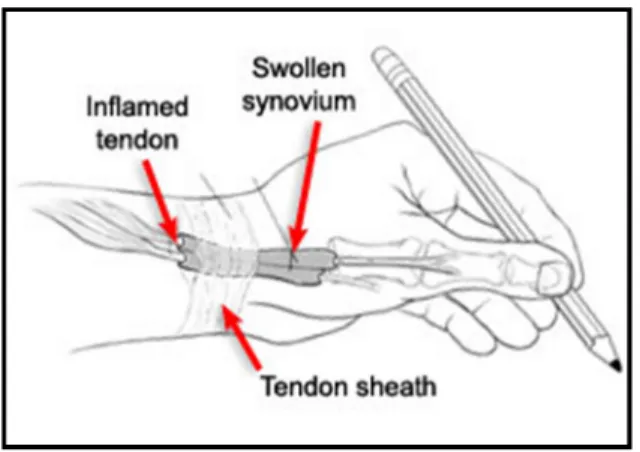 Figure 2. De Quervains tenosynovitis of the first extensor compartment                  (Griffin, 2005) 